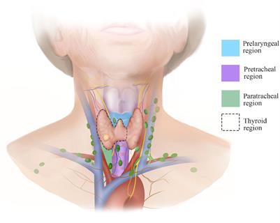 The updated surgical steps of gasless transaxillary endoscopic thyroidectomy with neck level and region orientation for thyroid cancer